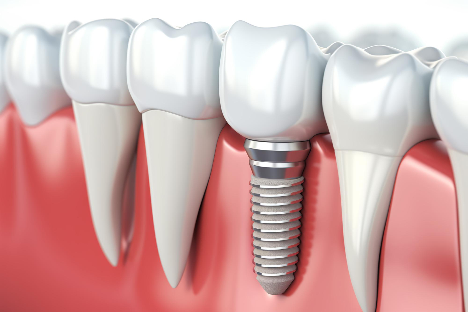 Bild Implantat
